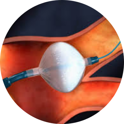 Cryoablation