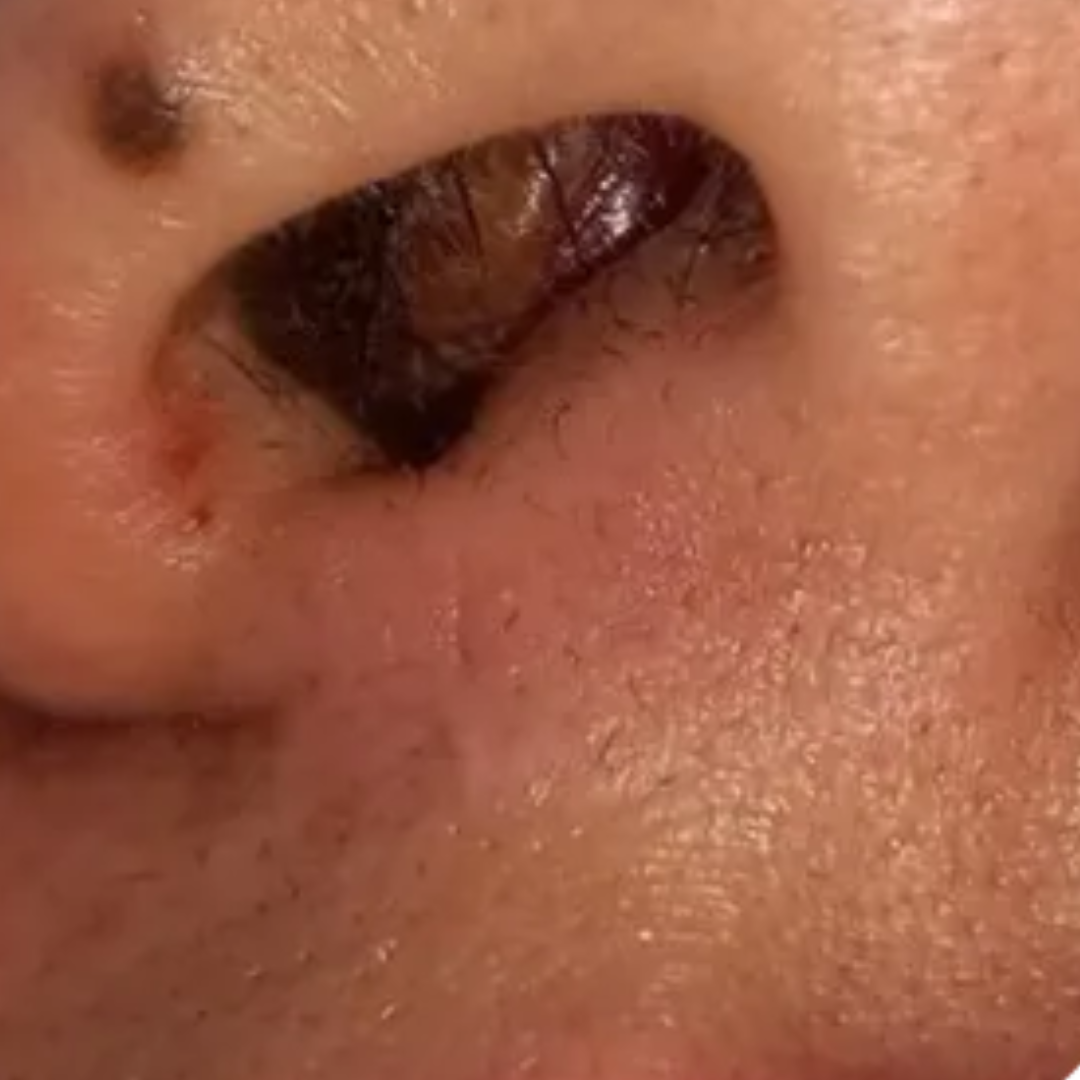 Nasal obstruction