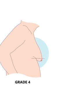 Asymmetric or Unilateral Gynecomastia