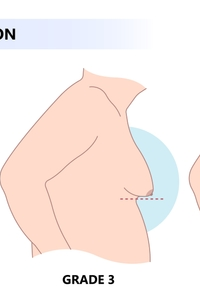 Adolescent Gynecomastia