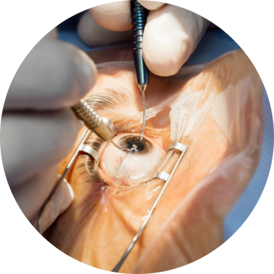 Phacoemulsification (Phaco)
