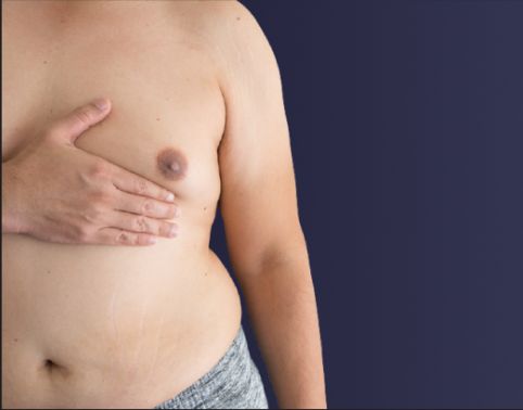 Gynecomastia Surgery