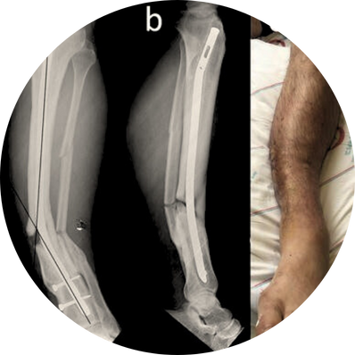 Emergency Implant Removal