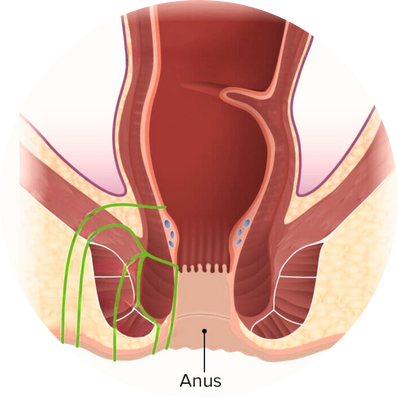 Submucosal Fistula