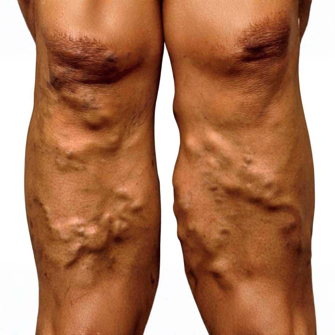 Dilated and tortured veins