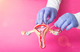 Tubal ligation (sterilization)