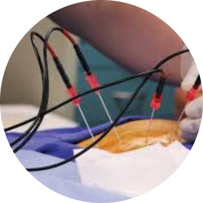 Radiofrequency Ablation
