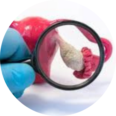 Unilateral Cystectomy