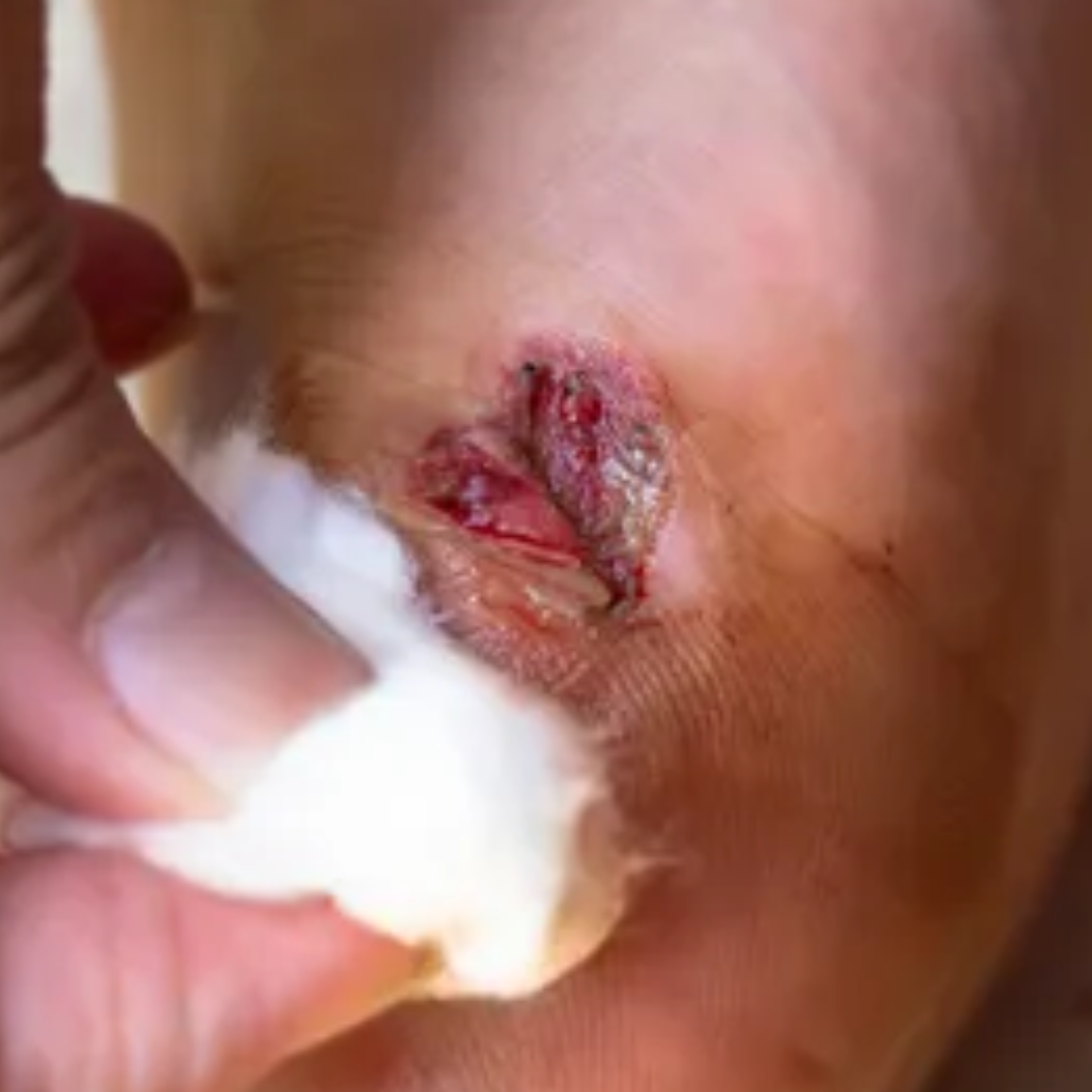 Infected wounds with pus, foul odor, or discharge