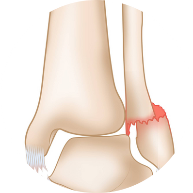 Displaced fracture