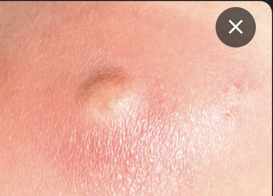 Swelling or a lump near the anus