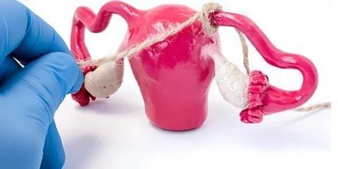 Tubal Ligation