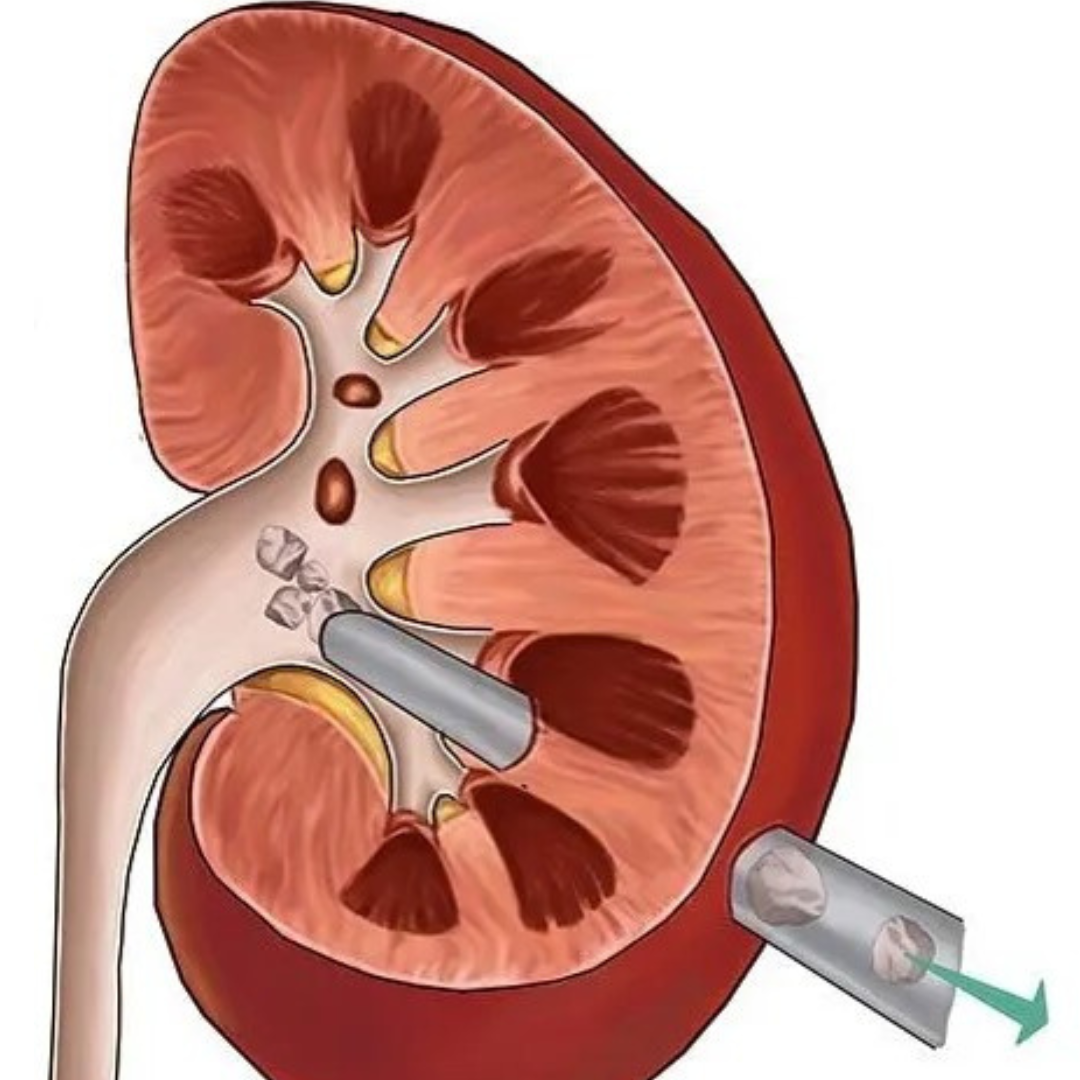 Staghorn calculi (branching stones filling renal pelvis and calyces)
