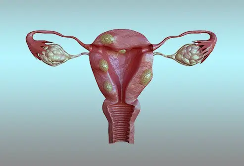 Bleeding not due to cancer, fibroids, or polyps (these are ruled out first)