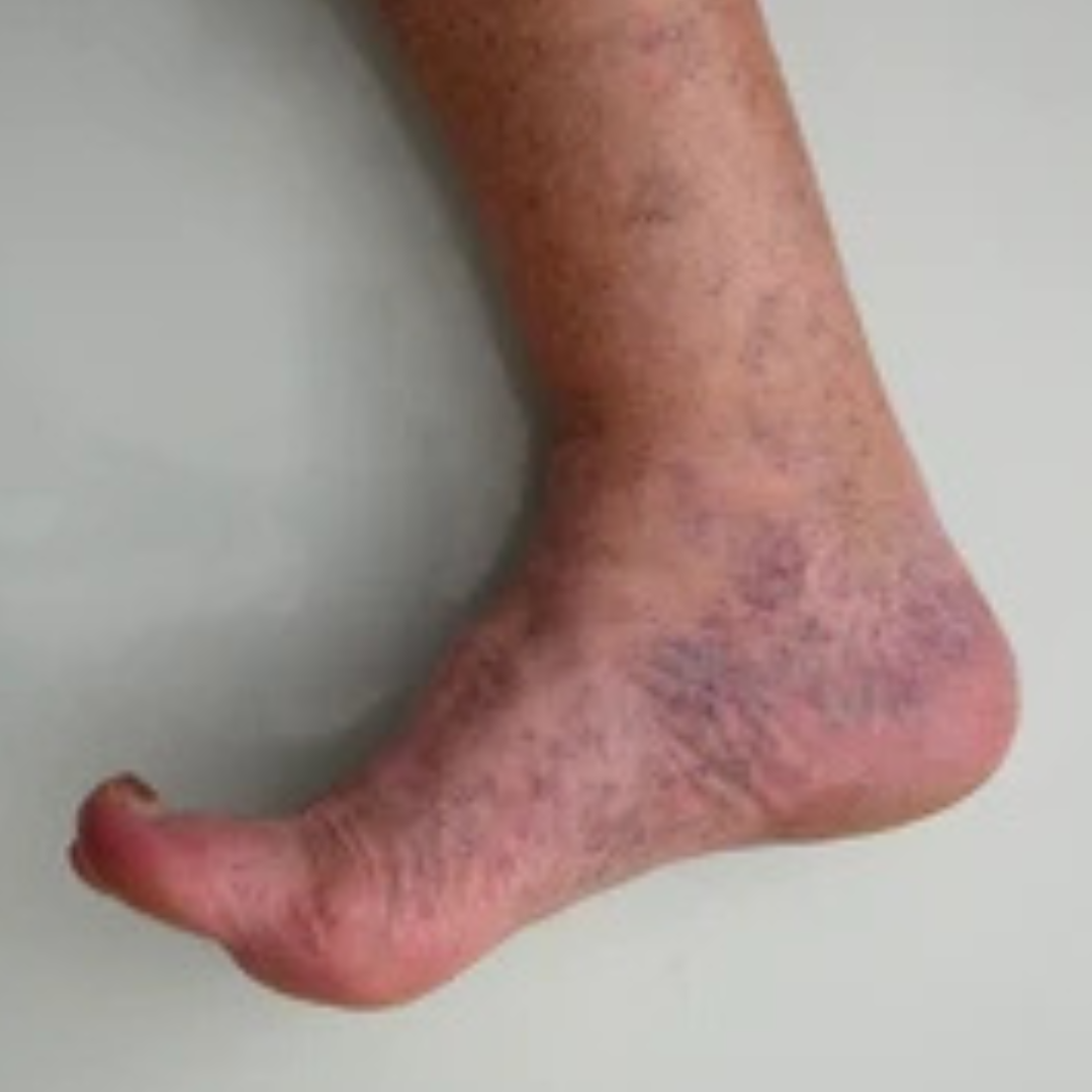 Skin discolorations and ulcers
