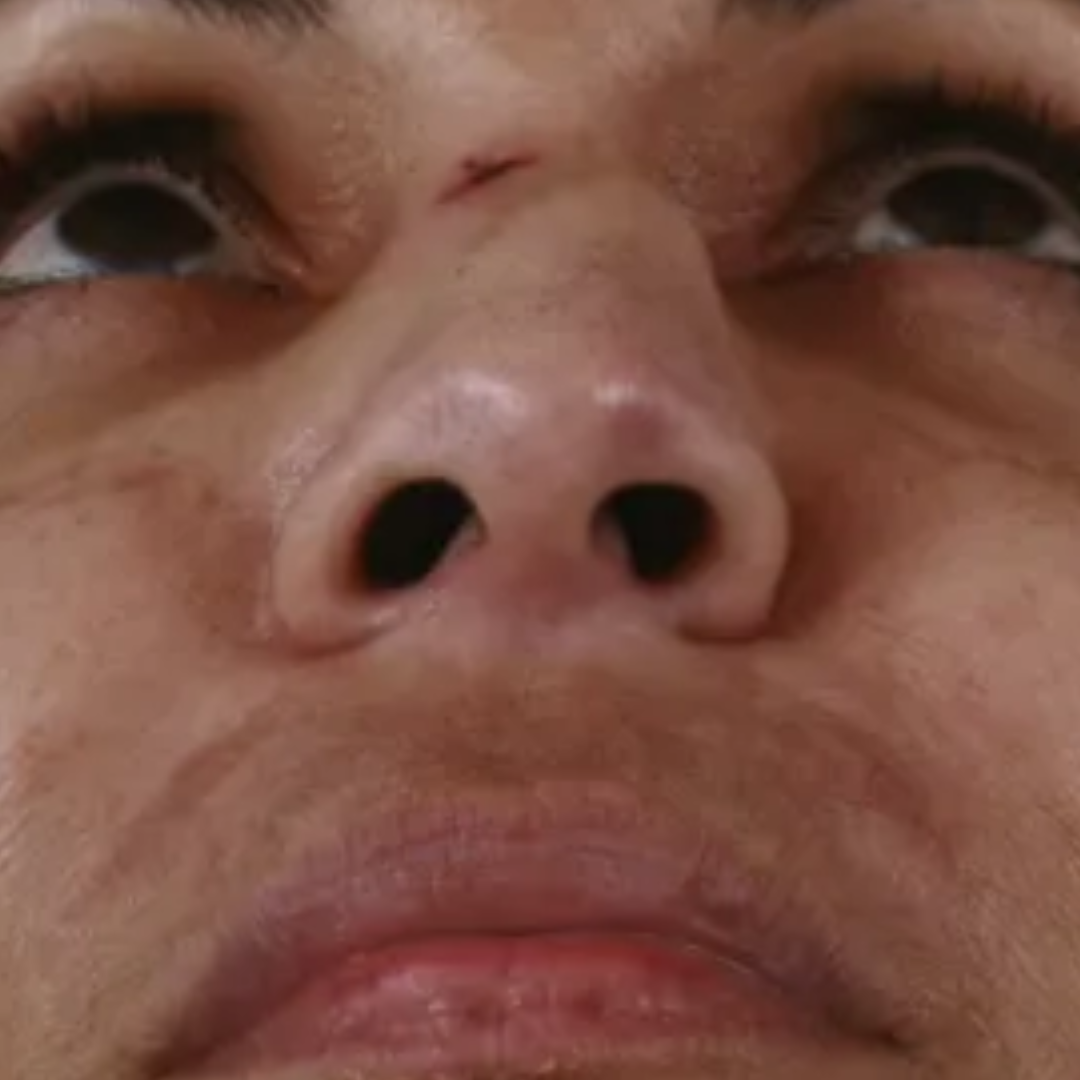 Visible nasal deformity or crooked nose after trauma