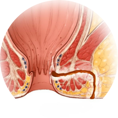 Secondary Fissure