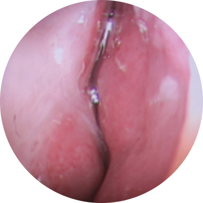 Anterior deviation