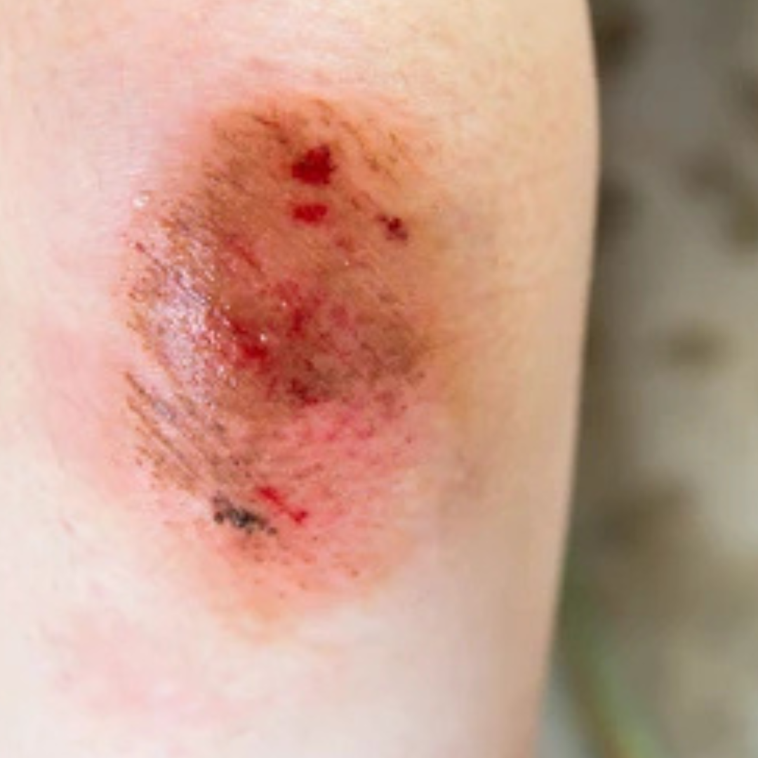 Swelling, bruising, or tenderness