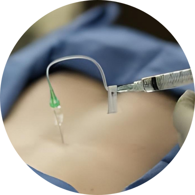 Continuous Caudal Epidural
