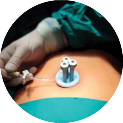 Single-Incision (SILS) Cholecystectomy