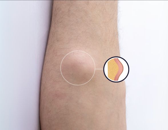 Lipoma Removal