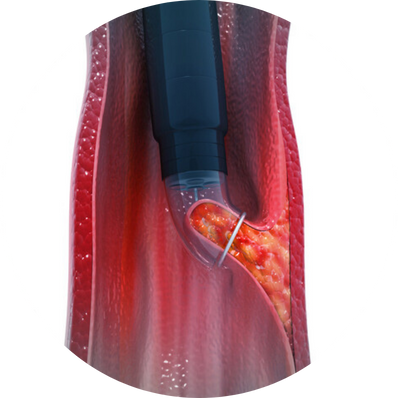 To diagnose endometrial conditions