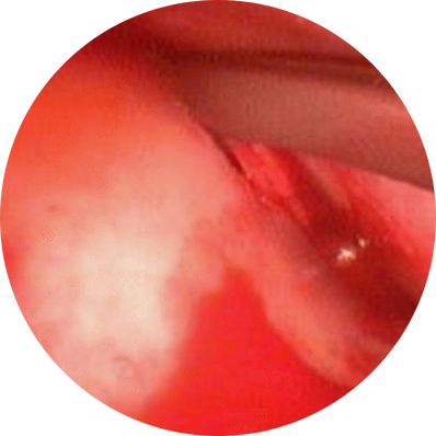 Posterior deviation