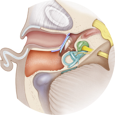 Canal Wall Up vs. Canal Wall Down Mastoidectomy