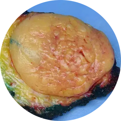 Spindle Cell Lipoma