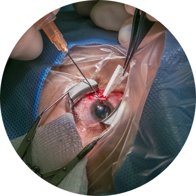 Extracapsular Cataract Extraction