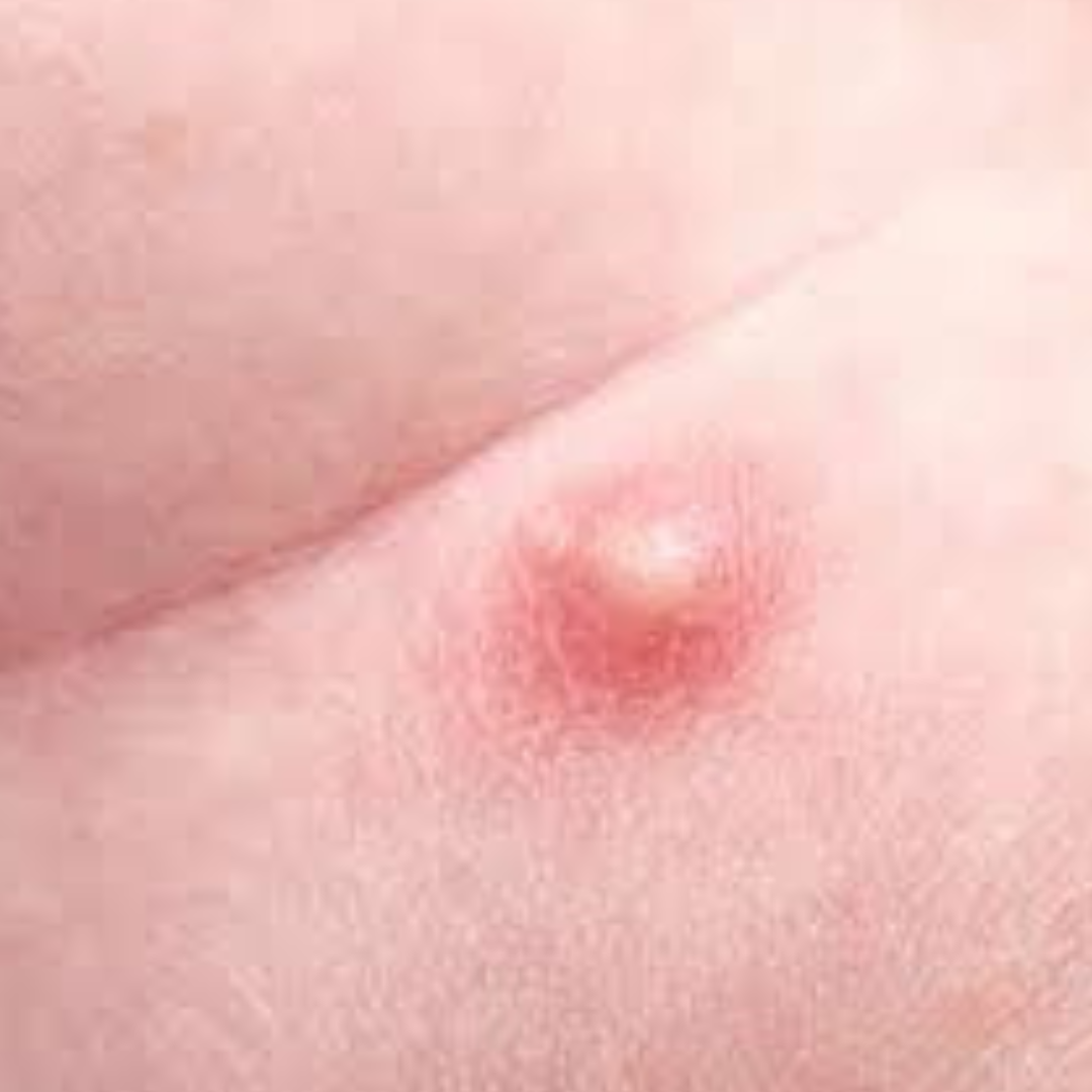 Recurrent abscess formation