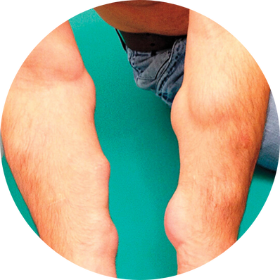 Multiple Lipomatosis