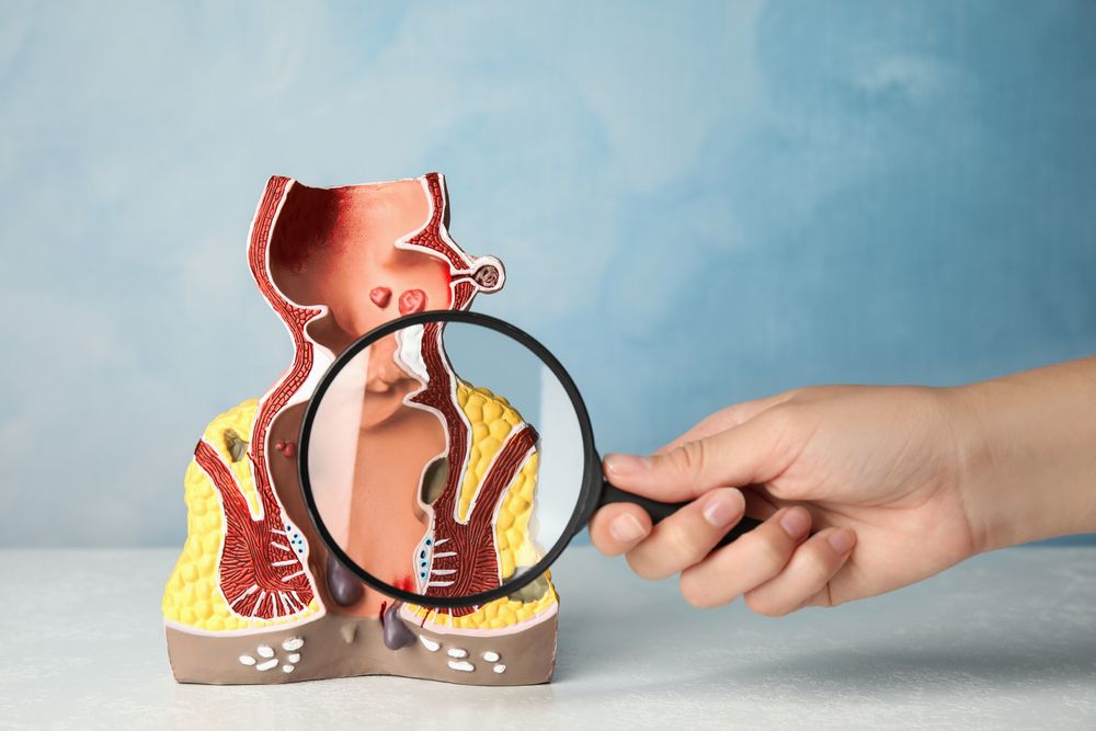 Anal Fistula