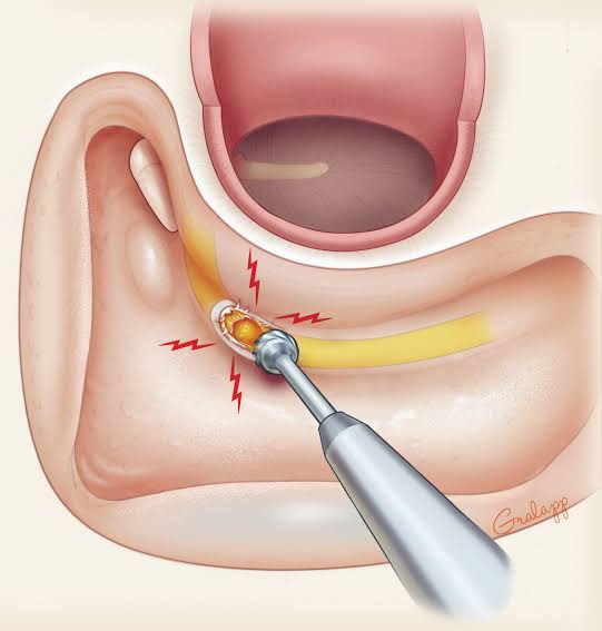 Mastoidectomy