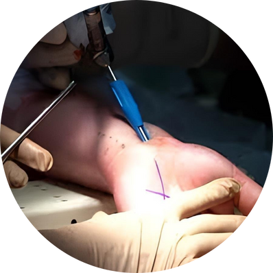 Endoscopic Release Surgery