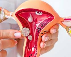 Uterine fibroids causing pain, bleeding, or pressure