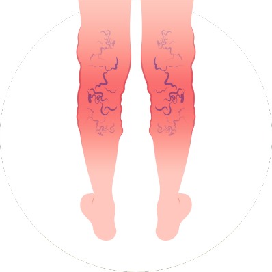 Spider Veins