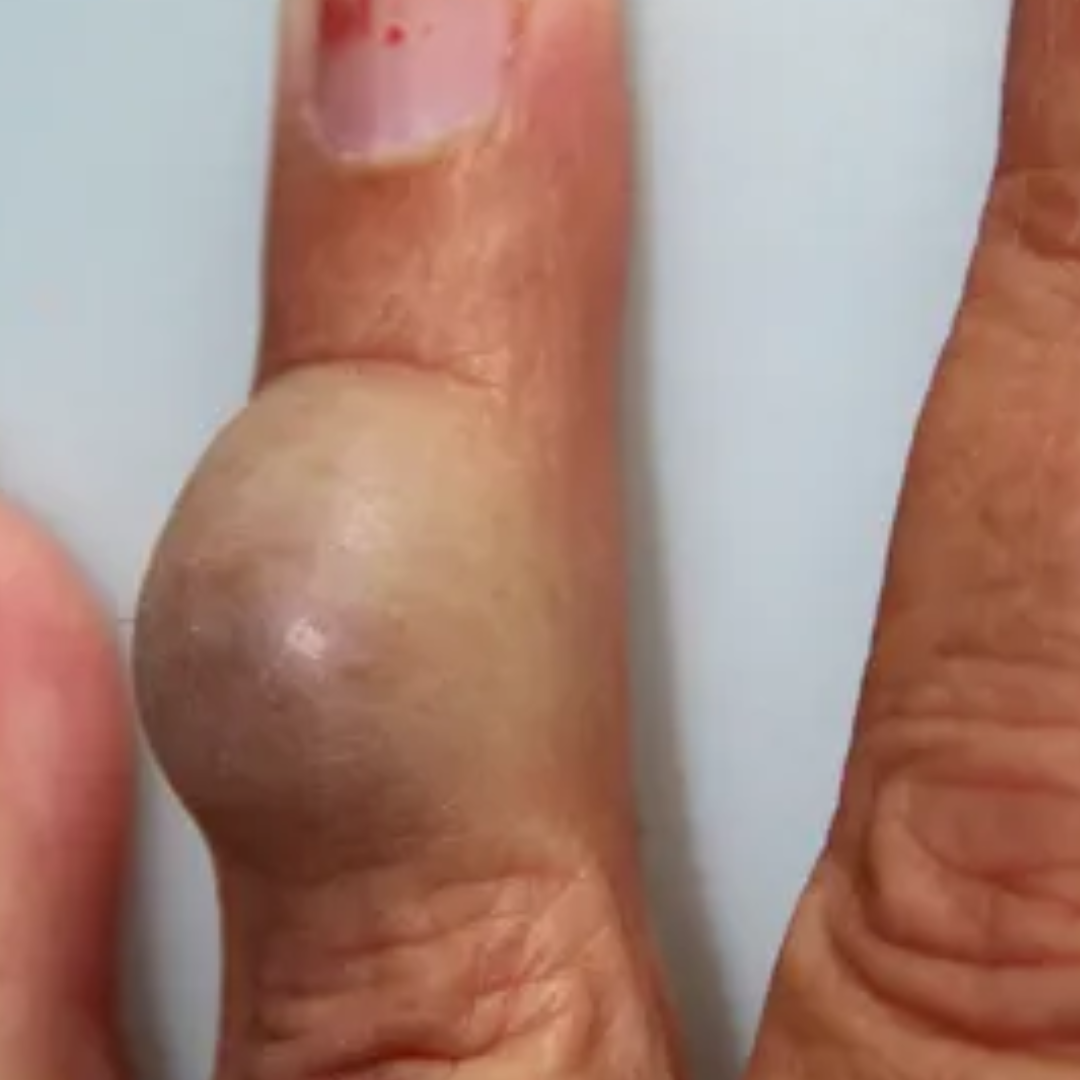 Lump or nodule near the tendon