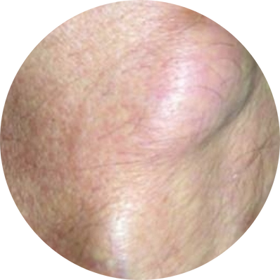 Fibrolipoma