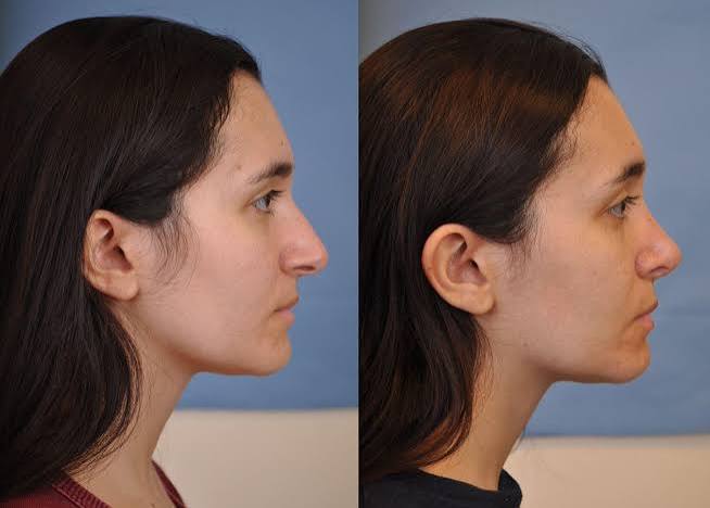 Septoplasty