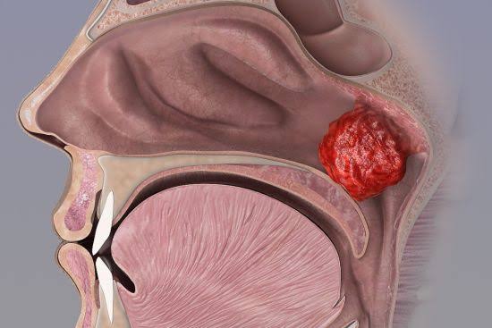 Adenoidectomy