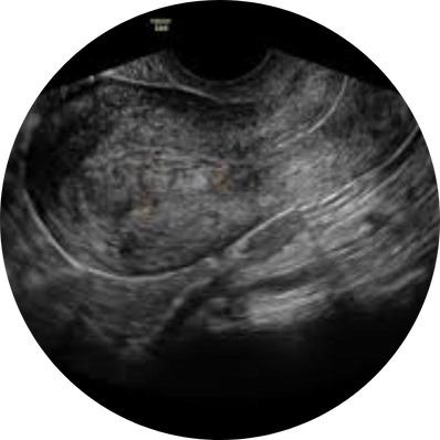 Retained products of conception