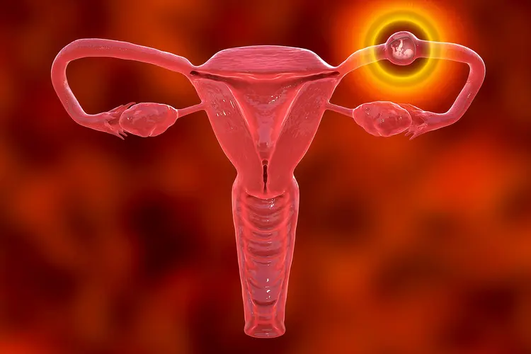 Ectopic pregnancy