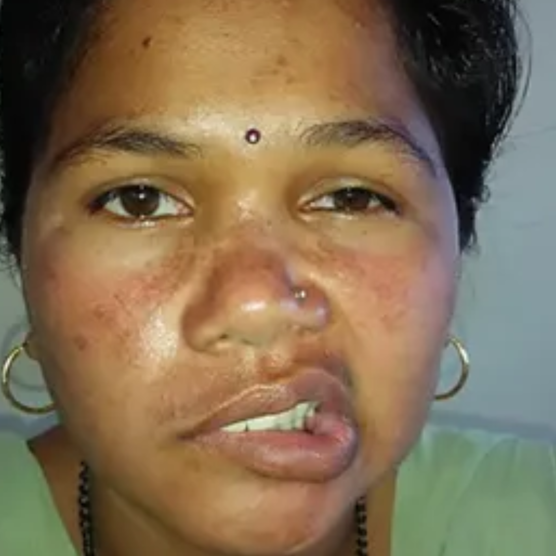 Facial weakness/paralysis caused by ear infection