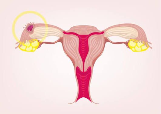 Ectopic Pregnancy