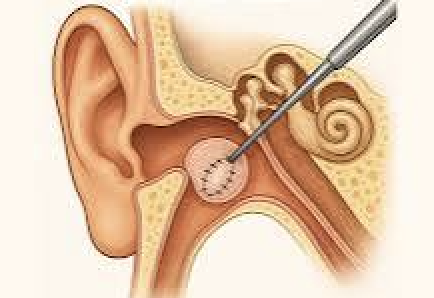 Tympanoplasty