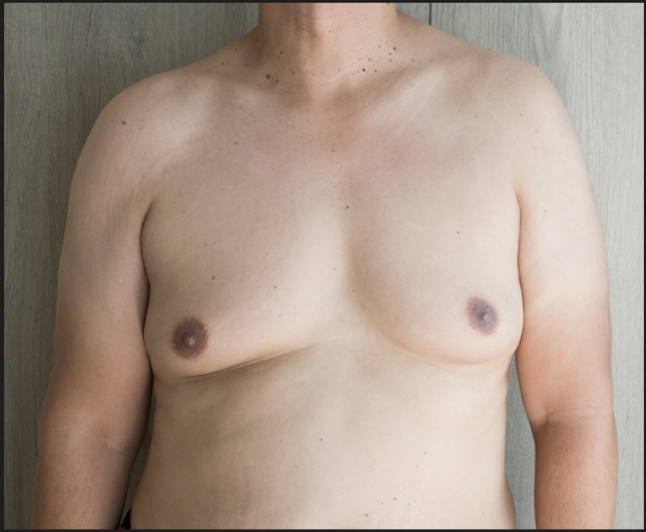 Persistence of enlarged breast tissue despite weight loss or medical treatment