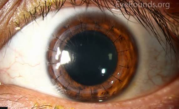 Full-Thickness Penetrating Keratoplasty (Corneal Transplant)