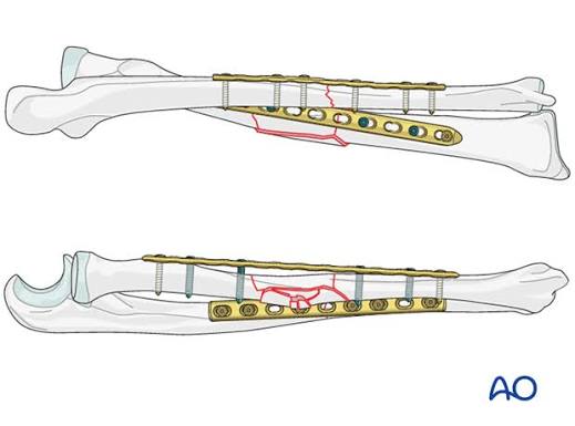 Forearm Plating